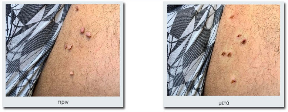 Ακροχορδώνες ( Skin tags ), μηροβουβωνικών πτυχών, πριν και μετά την αναίμακτη αφαίρεση με LASER: